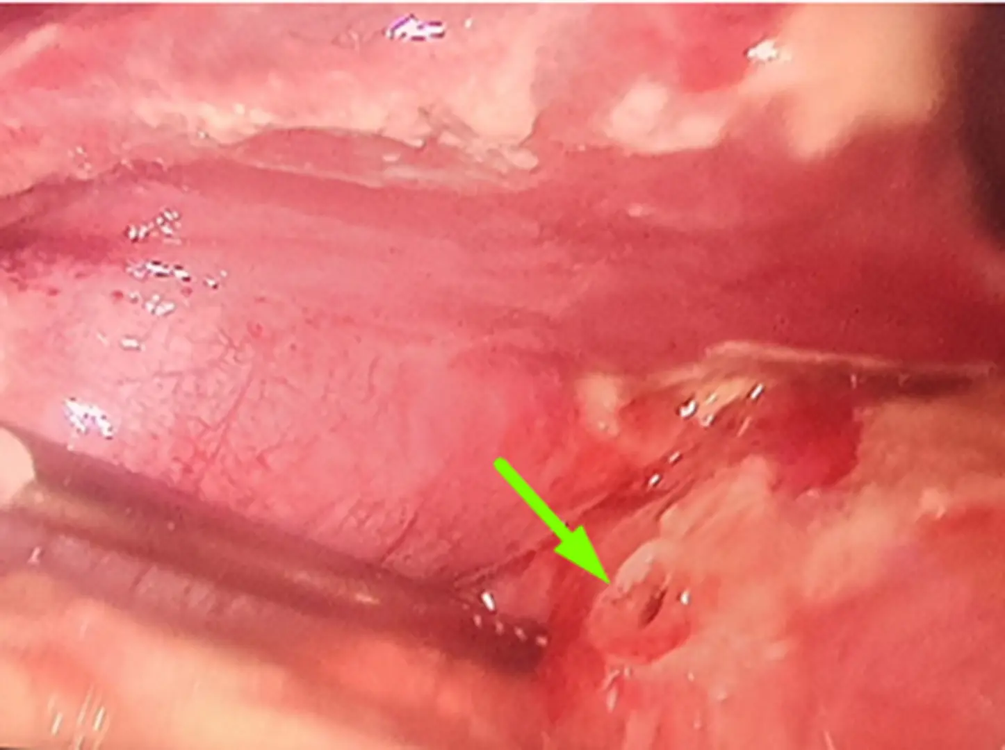 Áp lực thi cử, một nam sinh nhập viện do loét hành tá tràng nặng