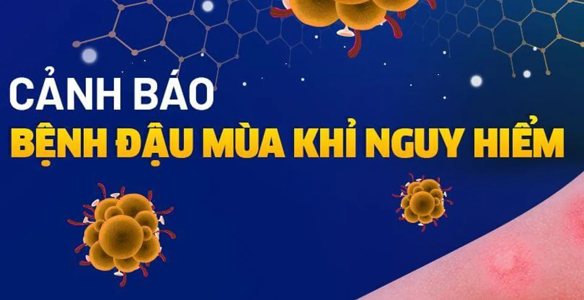 Dập tắt ổ dịch đậu mùa khỉ tại Cà Mau