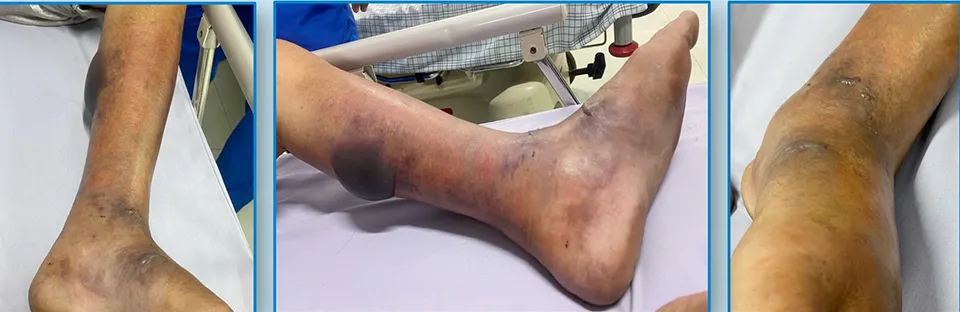Ăn tiết mua ở chợ, cụ ông 72 tuổi nhiễm liên cầu lợn
