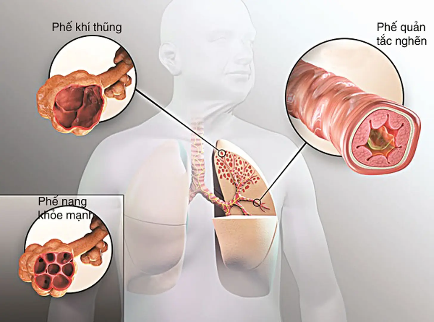 Bệnh phổi tắc nghẽn mãn tính rất dễ biến chứng