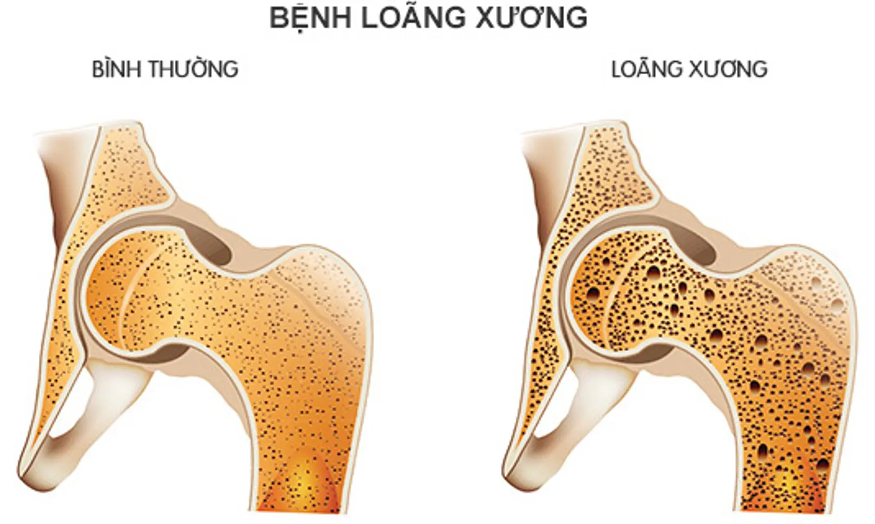 Đôi điều về ăn uống và bệnh loãng xương