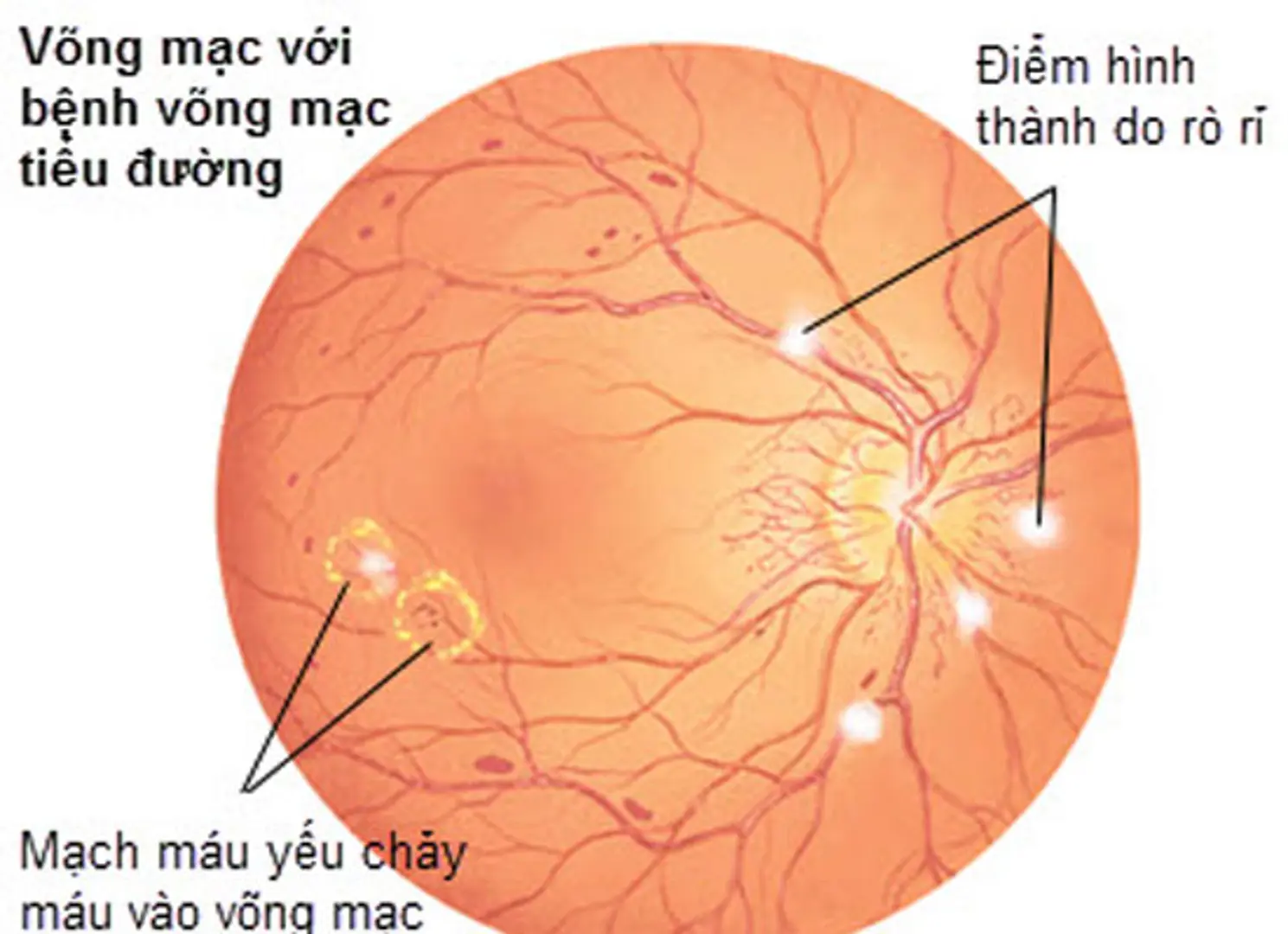 Thận trọng với bệnh lý võng mạc đái tháo đường