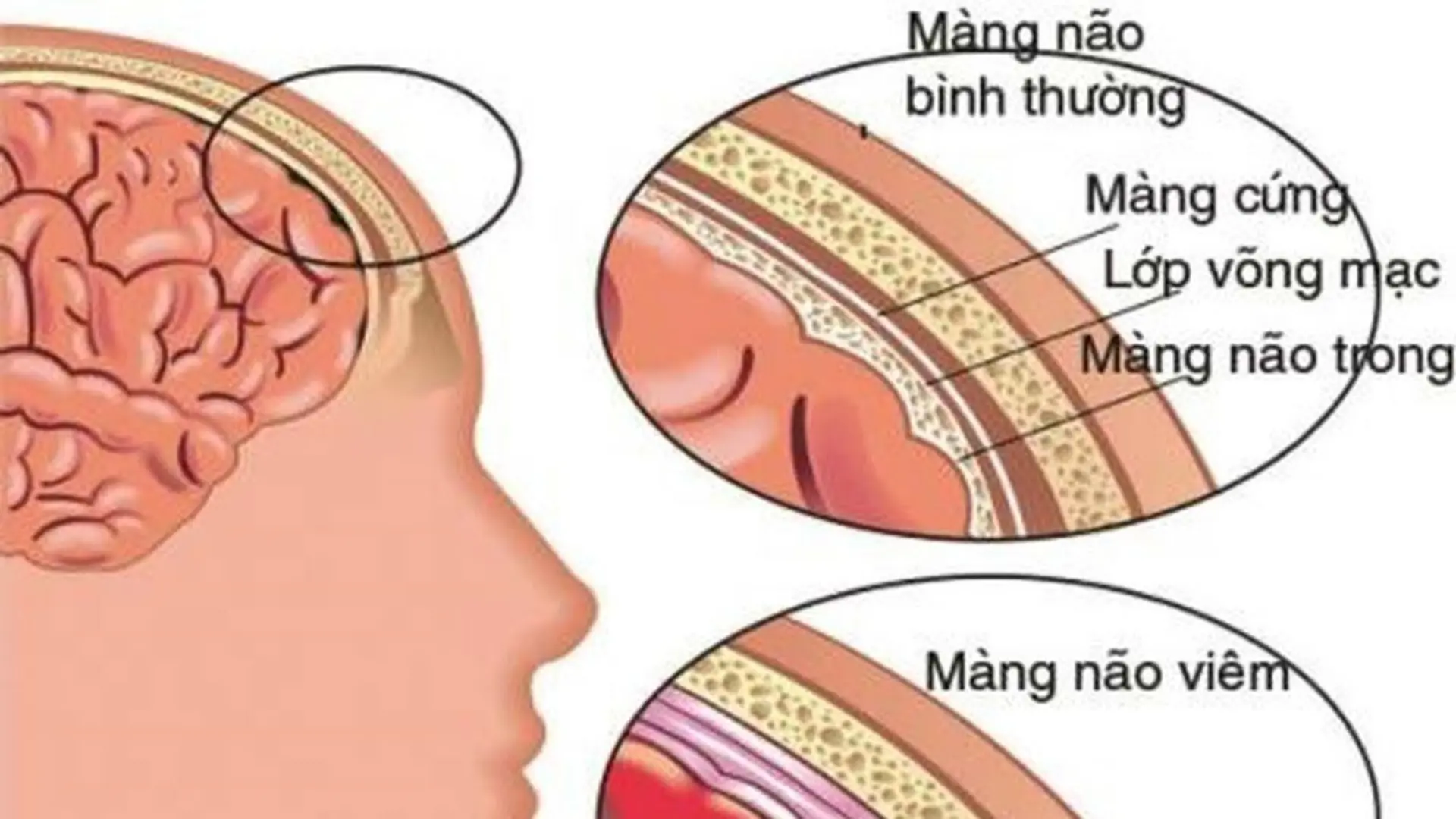 Bệnh viêm màng não ở trẻ em rất nguy hiểm, có thể dẫn đến tử vong