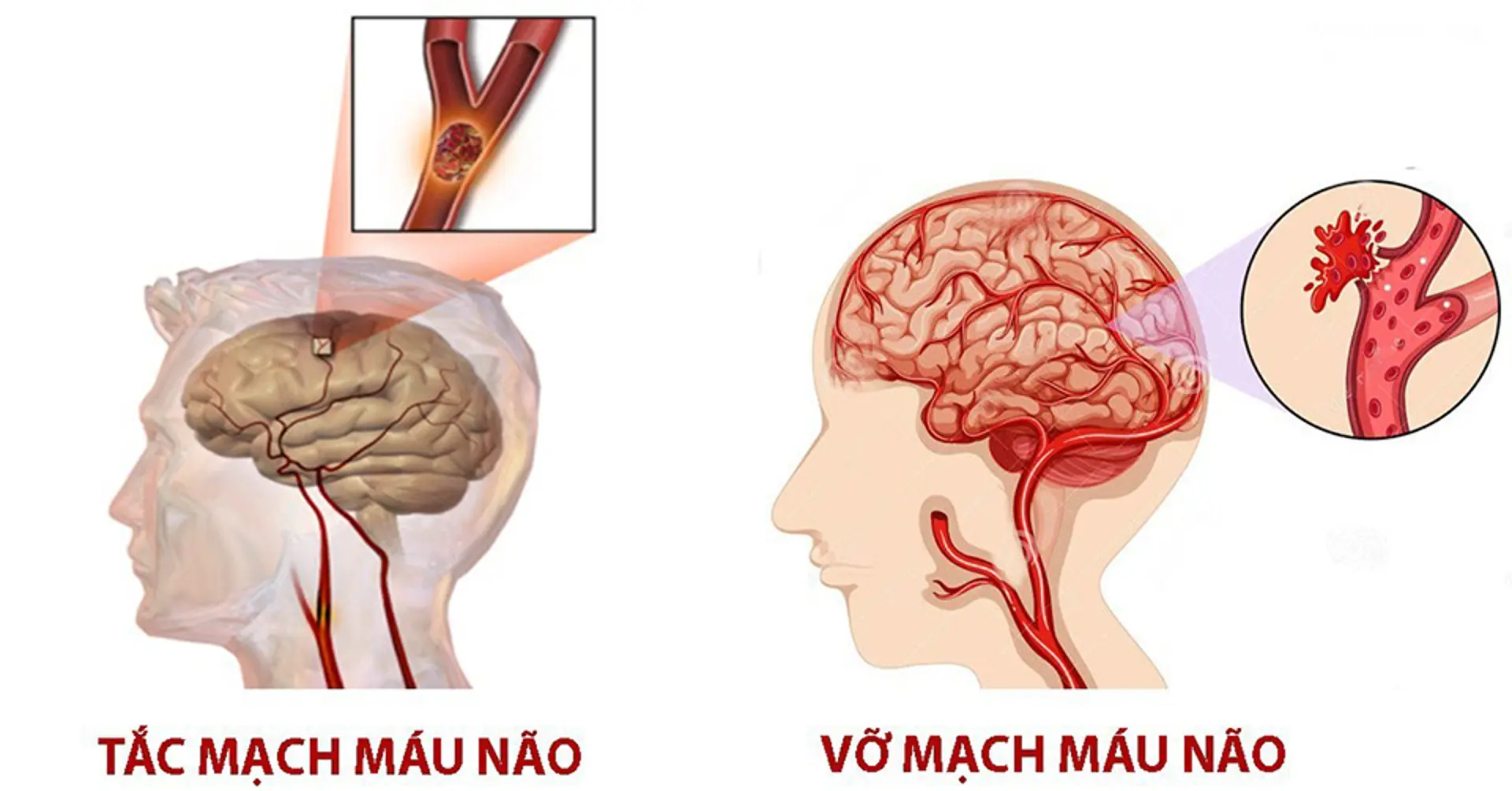 Chuyên gia chỉ cách nhận biết sớm và sơ cứu bệnh nhân đột quỵ não