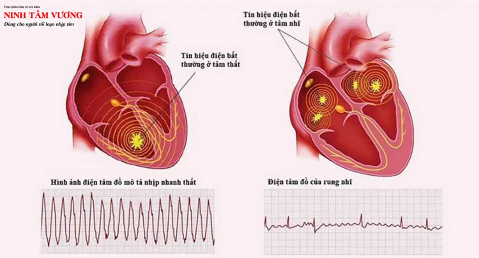 Cắt giảm rượu sẽ giúp ích nếu bạn bị rung nhĩ