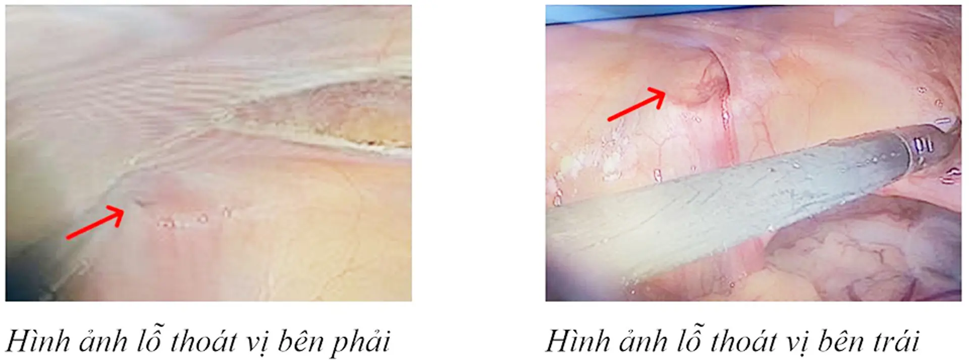 Thoát vị bẹn ở nữ: Gây biến chứng cao, liên quan đến bất thường giới tính