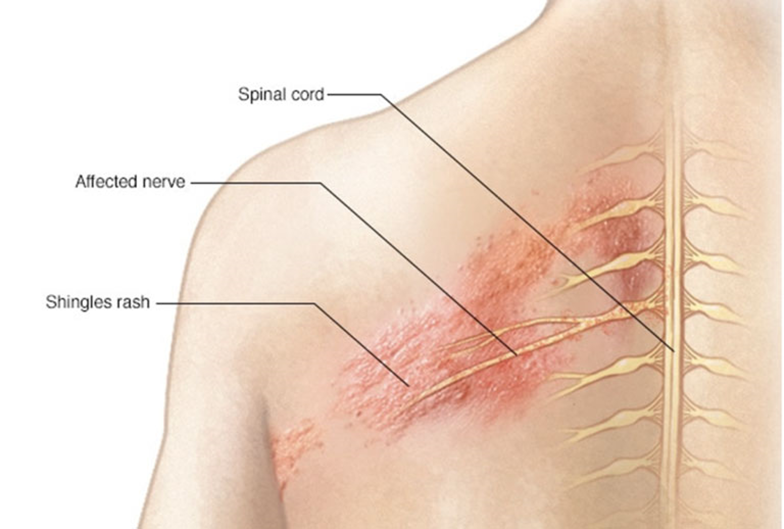 Bệnh zona thần kinh: Triệu chứng và cách điều trị