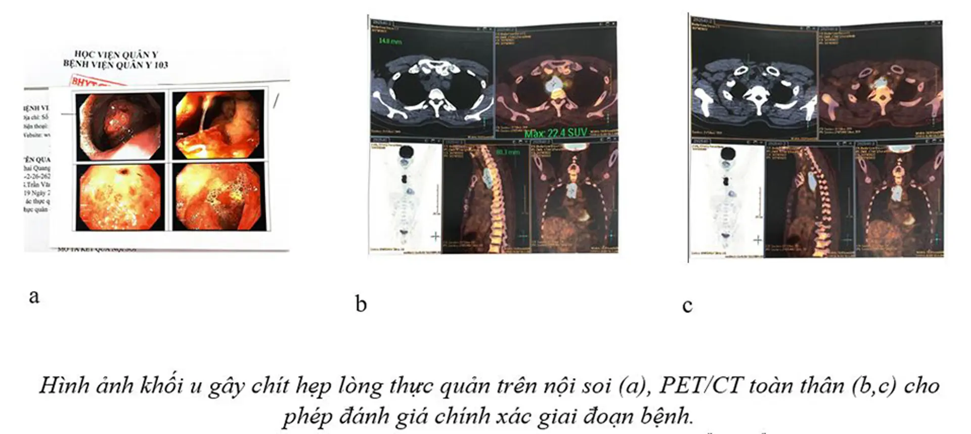 Điều trị thành công bước đầu cho bệnh nhân ung thư thực quản 