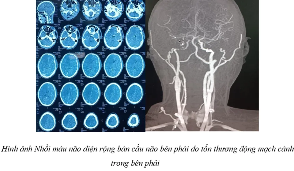 Không chủ quan với tổn thương mạch máu não sau chấn thương sọ não
