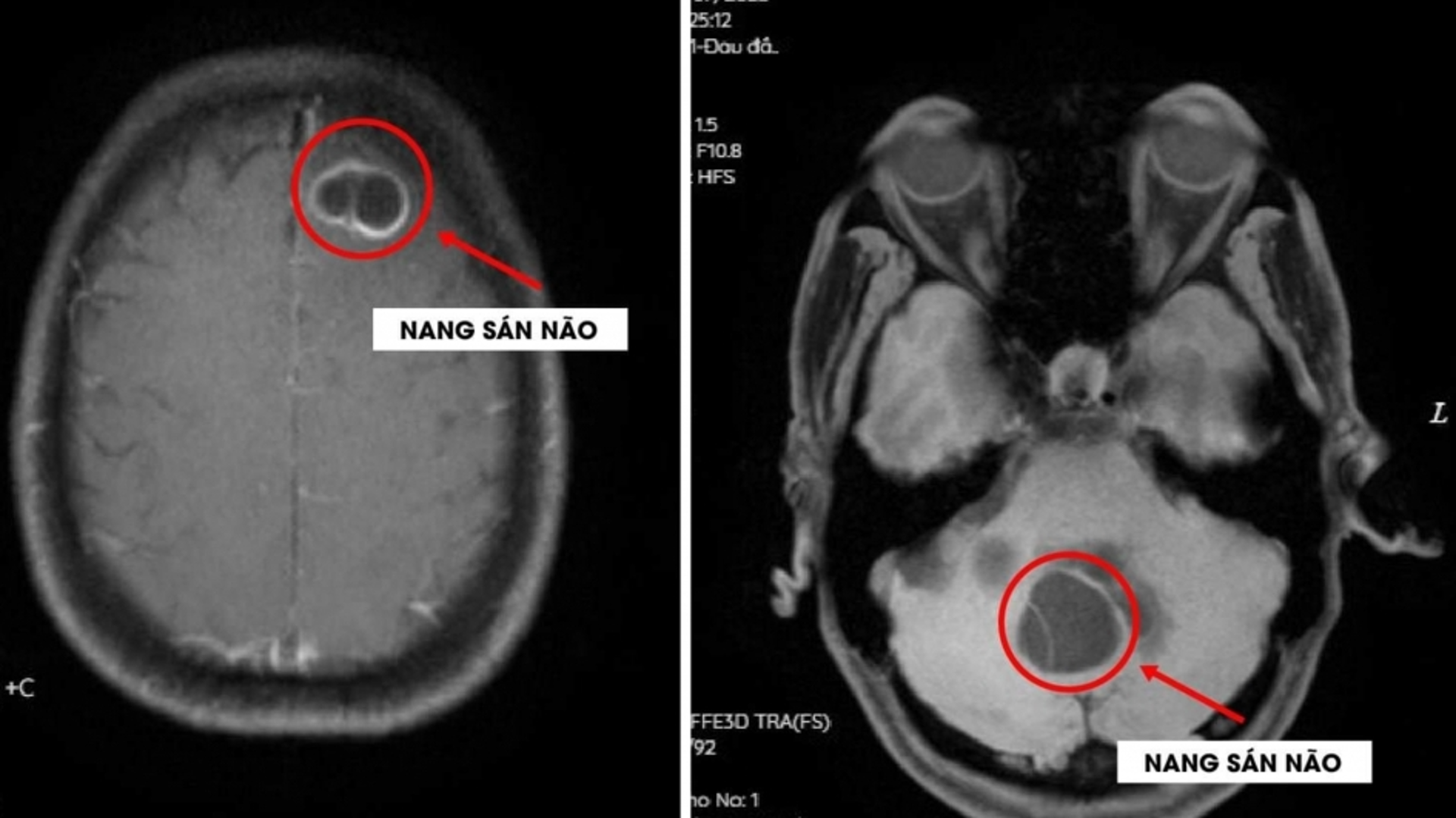 Cẩn trọng với nang sán não do thói quen ăn tiết canh sống