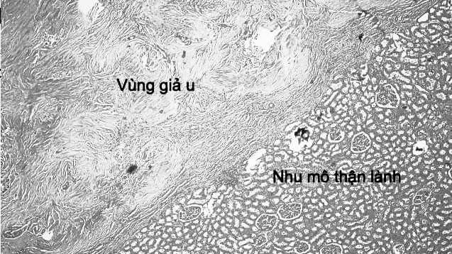 Gạc phẫu thuật bị bỏ quên tạo khối giả u thận sau 14 năm