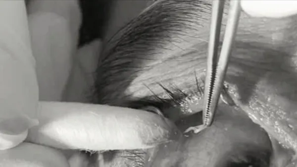 Đau mắt vì giun đũa chó, mèo sống trong kết mạc