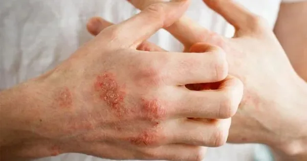 Dấu hiệu và cách điều trị bệnh ghẻ trong mùa mưa bão, lũ lụt
