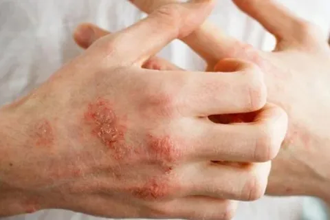 Dấu hiệu và cách điều trị bệnh ghẻ trong mùa mưa bão, lũ lụt
