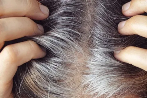 Nguyên nhân khiến tóc bạc sớm ở người trẻ