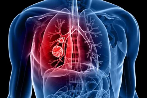 Các bệnh về phổi phổ biến nhất hiện nay