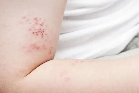 Bác sĩ tại nhà: Nhận biết và điều trị tổn thương do zona thần kinh
