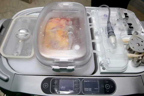 Bước ngoặt trong y học Việt Nam: Lần đầu tiên ghép thận bằng công nghệ bảo quản hạ nhiệt liên tục