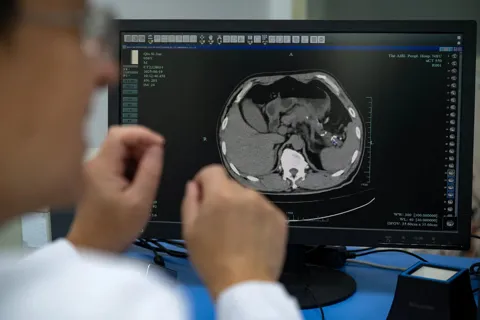 Trung Quốc: công cụ AI giúp phát hiện sớm ung thư tụy