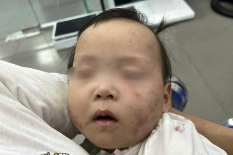 Bắc Ninh: làm rõ vụ bé gái bị bầm tím mặt khi gửi tại nhà trẻ tư thục