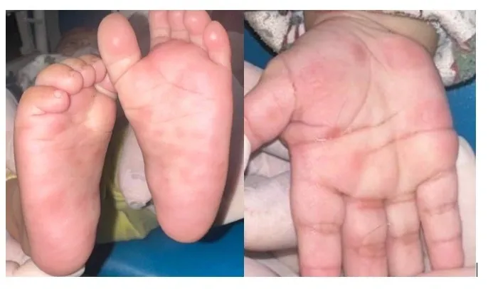 Bệnh nhi 4 tháng tuổi bị nhiễm giang mai