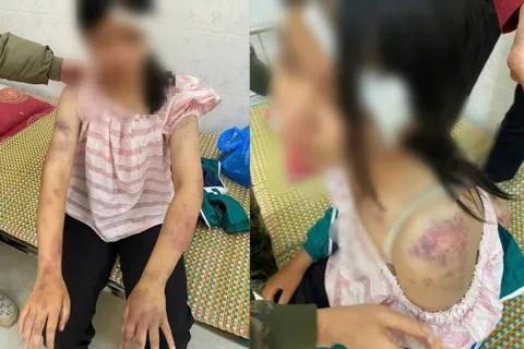 Bé gái bị bạo hành dã man tại Thái Nguyên