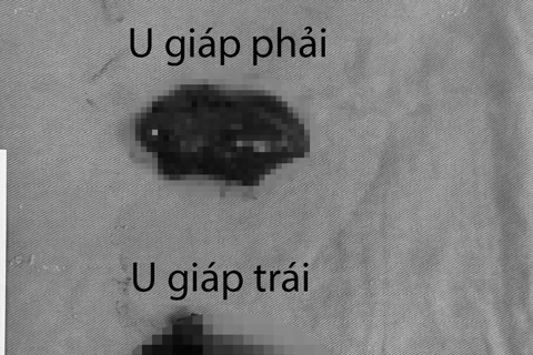 Suýt mất mạng vì chủ quan với bướu giáp lành tính