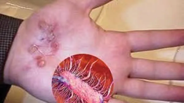 Đắk Lắk: ghi nhận 2 bệnh nhân mắc bệnh Whitmore