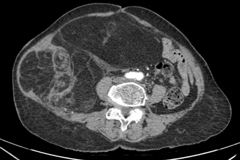 Phẫu thuật thành công khối u ác tính nặng gần 4kg cho bệnh nhân 
